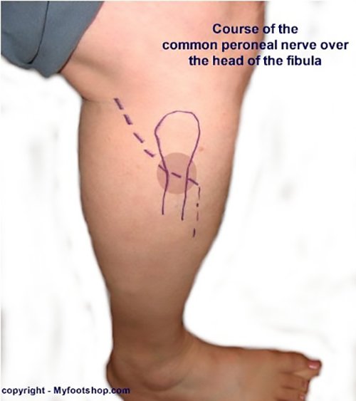 Understanding Peroneal Nerve Entrapment Lateral Knee Pain